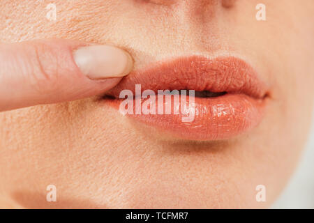 7/8-Ansicht von kranken Frau Herpes auf den Lippen berühren. Stockfoto