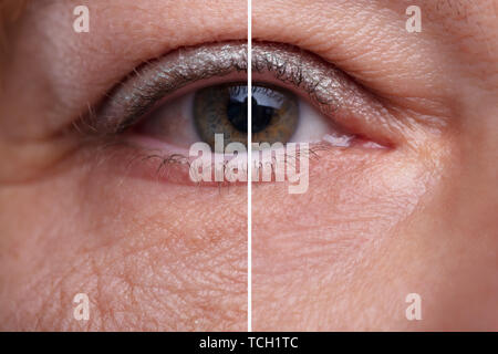 Close-up Woman's Eye Beutel Vor und Nach der kosmetischen Behandlung Stockfoto