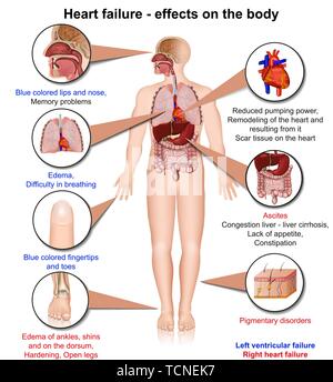 Hearth ausfall Auswirkungen des Körpers 3d medical Vector Illustration, Infografik auf weißem Hintergrund Stock Vektor