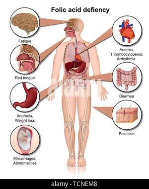Folsäure defiency 3d medical Vektor-illustration Infografik eps 10. Stock Vektor