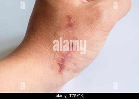 Die Narbe an seinem Arm in der Nähe des Handgelenks auf einem weißen Hintergrund. Zwei Narben nebeneinander auf den Arm, close-up. Nicht isoliert. Stockfoto