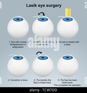 Lasik Auge Chirurgie medizinische Vector Illustration auf weißem Hintergrund eps Infografik Stock Vektor