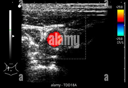 Halsschlagader, Doppler Ultraschall Stockfoto
