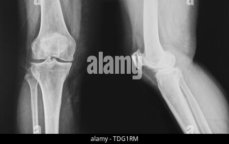 Sammlung von x-ray normal Knie Stockfoto