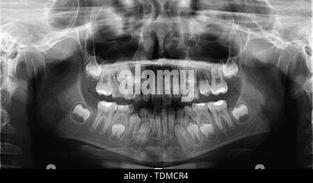 X-ray-Scan der Kinder Zähne. Panoramablick auf das negative Image der das Gesicht des Kindes. Das Bild war für eine zahnmedizinische Diagnostik an einer klinischen Prüfung getroffen. Stockfoto