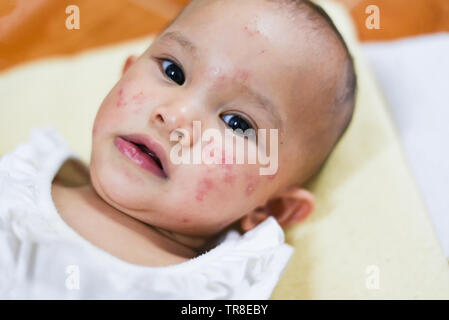 Baby Allergie Hautausschlag im Gesicht/Krankheit baby girl Gesicht Trockene Haut Juckreiz und Läsion verursacht von Allergie in den neugeborenen Asien Stockfoto