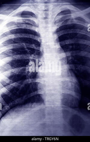 In der Nähe bild von X-ray von der Brust Stockfoto