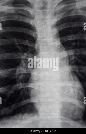 X-Ray Image der menschlichen Brust für eine medizinische Diagnose Stockfoto