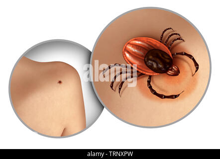 Deer tick Krabbeln auf der Haut als Lyme Krankheit Gesundheit Gefahr, als der Biss eines Parasiten Infektion verursacht in einer 3D-Darstellung. Stockfoto