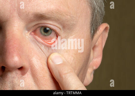 Close-up männliche Auge mit geröteten Augenlid und Hornhaut, Bindehautentzündung. Stockfoto