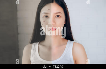 Vergleich der asiatischen Frau Akne Gesicht und Nach sauberes Gesicht wenn sie Hautpflege Make-up Cleansing Foam, Akne Gel. Stockfoto