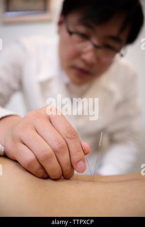 Akupunktur Nadeln, die auf der Person zurück Stockfoto