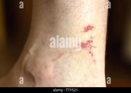 Close-up heilende Wunde am Bein des Menschen. Soft Focus Stockfoto