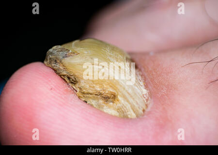 Makro Foto eines menschlichen Zehennagel mit Pilz Stockfoto