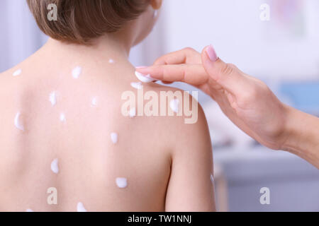 Frau Anwendung der Creme auf der Haut von Kind krank mit Windpocken, Nahaufnahme Stockfoto