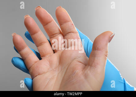 Arzt untersuchen Patienten mit Dermatitis an Hand, Nahaufnahme Stockfoto