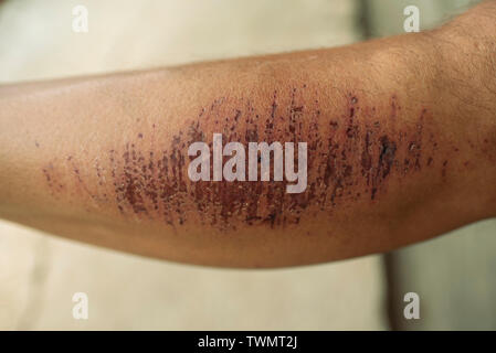 Hautschäden mit Tiefe Kratzer am Bein (als Folge eines Sturzes während einer Wanderung) auf erwachsenen Mann. RF Wundheilung Beispiel stock Bild. Stockfoto