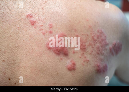 Schindeln (Krankheit), Herpes zoster, Varicella-zoster-Virus. Hautausschlag und Bläschen an der Karosserie Stockfoto