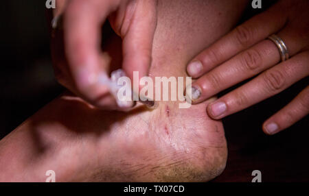 Eine Person, die mit einer hypodermischen Nadel selbst in den Fuß mit schwarzem Teer Heroin zu spritzen. Stockfoto