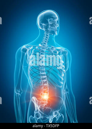 3D-gerenderte Medizinisch genaue Abbildung der unteren Wirbelsäule schmerzhaft Stockfoto