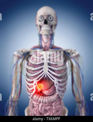 3D-gerenderte Medizinisch genaue Abbildung eines Leber Tumor Stockfoto