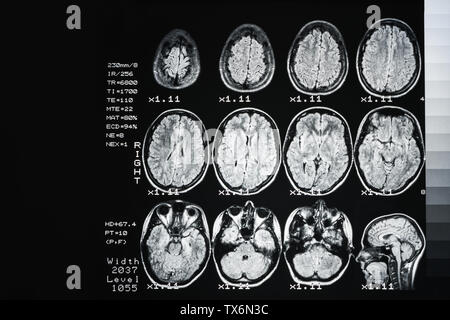 Das Ergebnis ist eine MRT des Gehirns mit Werte und Zahlen. Medizinischer Hintergrund Stockfoto