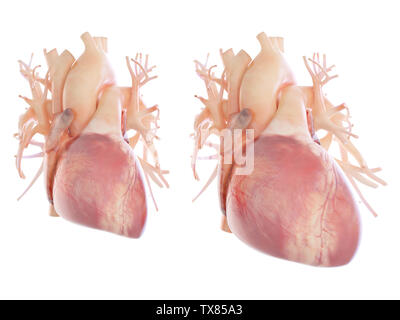 3D gerendert, medizinisch genaue Abbildung eines vergrößerten Herzen Stockfoto