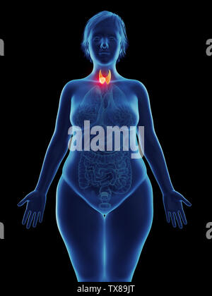 3D-gerenderte Medizinisch genaue Abbildung eines Tumors in a womans Schilddrüse Stockfoto