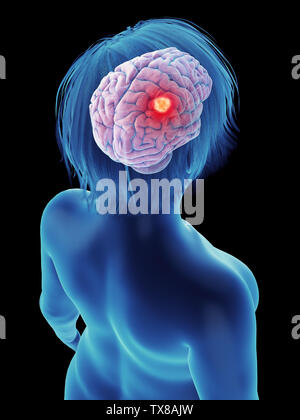 3D-gerenderte Medizinisch genaue Abbildung eines Tumors in a womans Gehirn Stockfoto