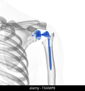 3D-gerenderte Medizinisch genaue Abbildung eines Schulter Austausch Stockfoto