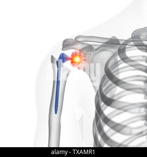 3D-gerenderte Medizinisch genaue Abbildung eines Schulter Austausch Stockfoto