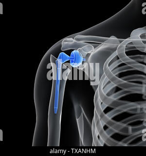3D-gerenderte Medizinisch genaue Abbildung eines Schulter Austausch Stockfoto