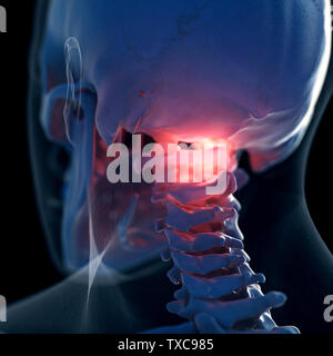 3D-gerenderte Medizinisch genaue Abbildung eines schmerzhaften Atlas Knochen Stockfoto