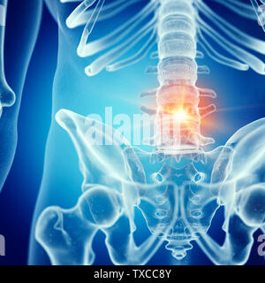3D-gerenderte Medizinisch genaue Abbildung: Schmerzen im unteren Rücken Stockfoto