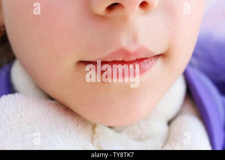 Herpes auf den Lippen des Kindes. Behandlung Salbe. Stockfoto