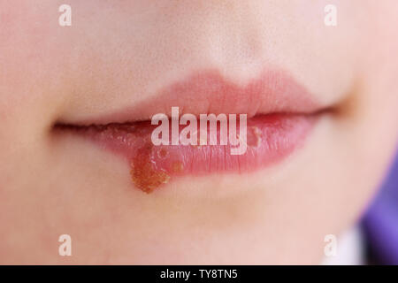 Herpes auf den Lippen des Kindes. Behandlung Salbe. Stockfoto