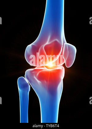 3D-gerenderte Medizinisch genaue Abbildung der Knie, Schmerzen Stockfoto