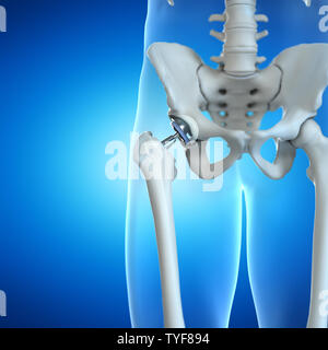 3D-Darstellung eines hip Implant Stockfoto