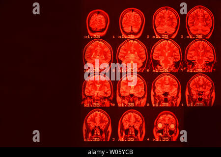 Mrt des Gehirns auf einem schwarzen Hintergrund mit roter Hintergrundbeleuchtung. Medizinischer Hintergrund Stockfoto
