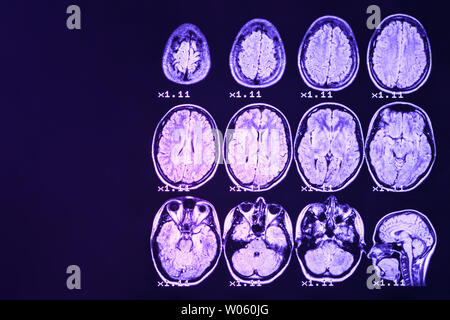 Mrt des Gehirns auf einem schwarzen Hintergrund mit blauer Hintergrundbeleuchtung. Richtige Ort für Werbung Beschriftung Stockfoto