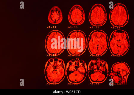 Mrt des Gehirns auf einem schwarzen Hintergrund mit roter Hintergrundbeleuchtung. Medizinischer Hintergrund Stockfoto