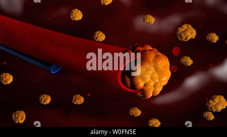Cholesterin und Arterie Grafik Herzinfarkt Stockfoto