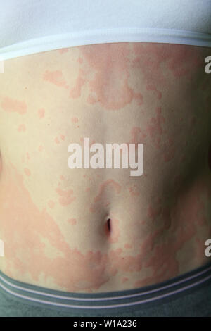 Allergische Dermatitis. Die Haut der Mädchen ist von Dermatitis erstaunt Stockfoto