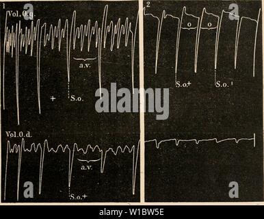 Archiv Bild von Seite 46 der Wörterbuch de Physiologie (1902). Wörterbuch de Physiologie. dictionnairedeph 05 reiche Jahr: 1902 DIGITALE. 37 Franck eine montrÃ, avec tracÃs graphiques à l'appui, que les Nerfs cardiaques modifient parallÃ¨lement, mais indÃpendamment, l'Ãnergie dos oreillettes et Celle des ventricules. L'action des Gifte du cÅur se produit dans le Sens: mÃªme leur action Ãlective Pfandrecht peut, en Effet, intÃresser plus particuliÃ¨rement Tel ou tel ÃlÃment anatomique, Mais non pas une rÃgion spÃciale. L'Enregistrement et des simultanÃ Veränderungen auriculaires ventriculaires, Au p Stockfoto