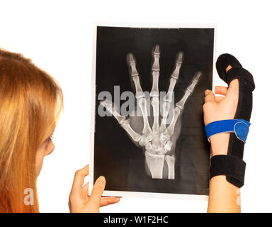 Nahaufnahme Porträt der jungen Frau mit bandagierten Finger lesen Handgelenk x-ray Stockfoto