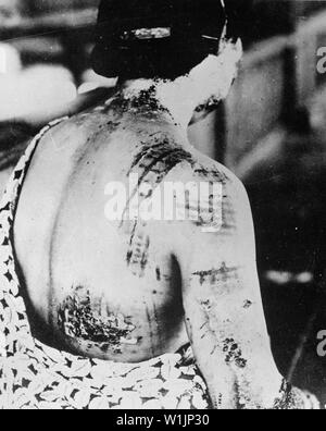 Die Haut des Patienten ist in einem Muster entspricht, die dunklen Bereiche eines Kimono zum Zeitpunkt der Explosion verbrannt getragen. Japan, das circa 1945.; Allgemeine Hinweise: Verwenden Sie Krieg und Konflikt Nummer 1244 bei der Bestellung eine Reproduktion oder Anforderung von Informationen zu diesem Bild. Stockfoto