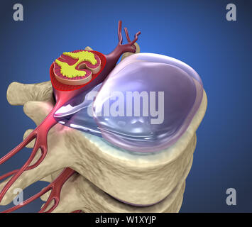 Hernaited Disc in der menschlichen Wirbelsäule in Details Stockfoto