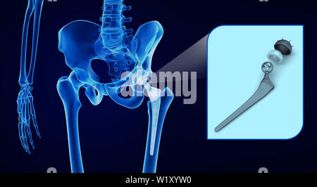 Hüftgelenkersatz-Implantat in den Knochen des Beckens installiert. Röntgenblick. Medizinisch genaue 3D-Illustration Stockfoto