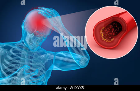 Schlaganfall: 3d Darstellung von Gefäßen des Gehirns und Ursachen eines Schlaganfalls Stockfoto