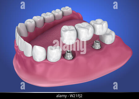 Unterstützt feste Brücke Implantat. Medizinisch genaue 3D-Darstellung Stockfoto